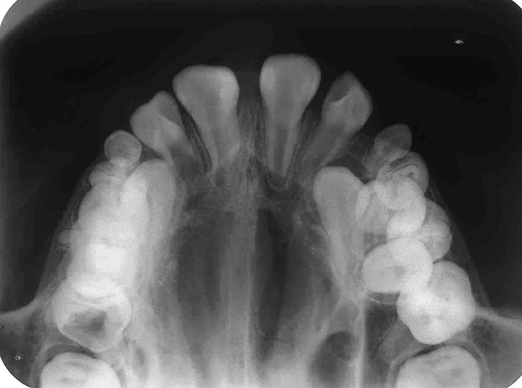 Oclusal